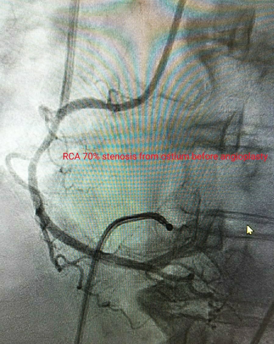 70% Stenosis