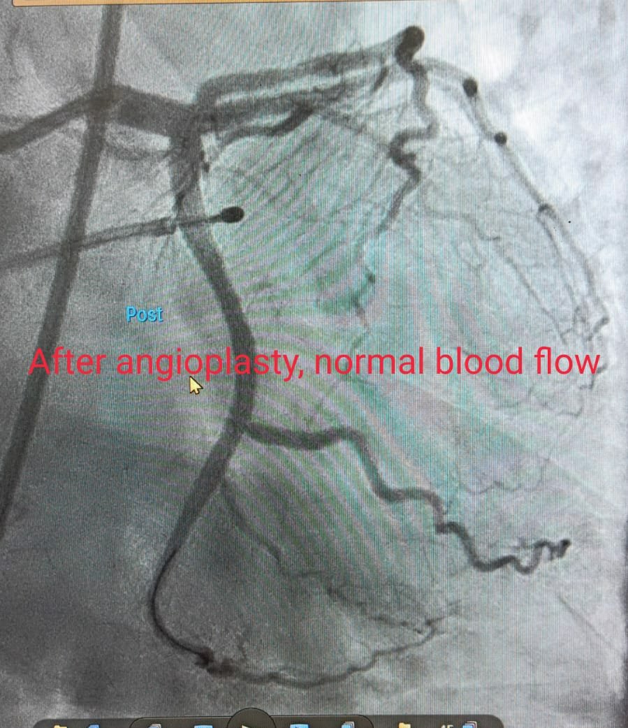 After Angioplasty Image