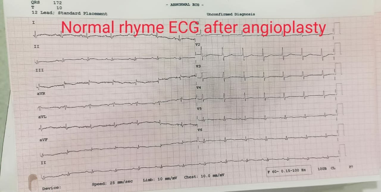 Normal rhyme ECG After angioplasty