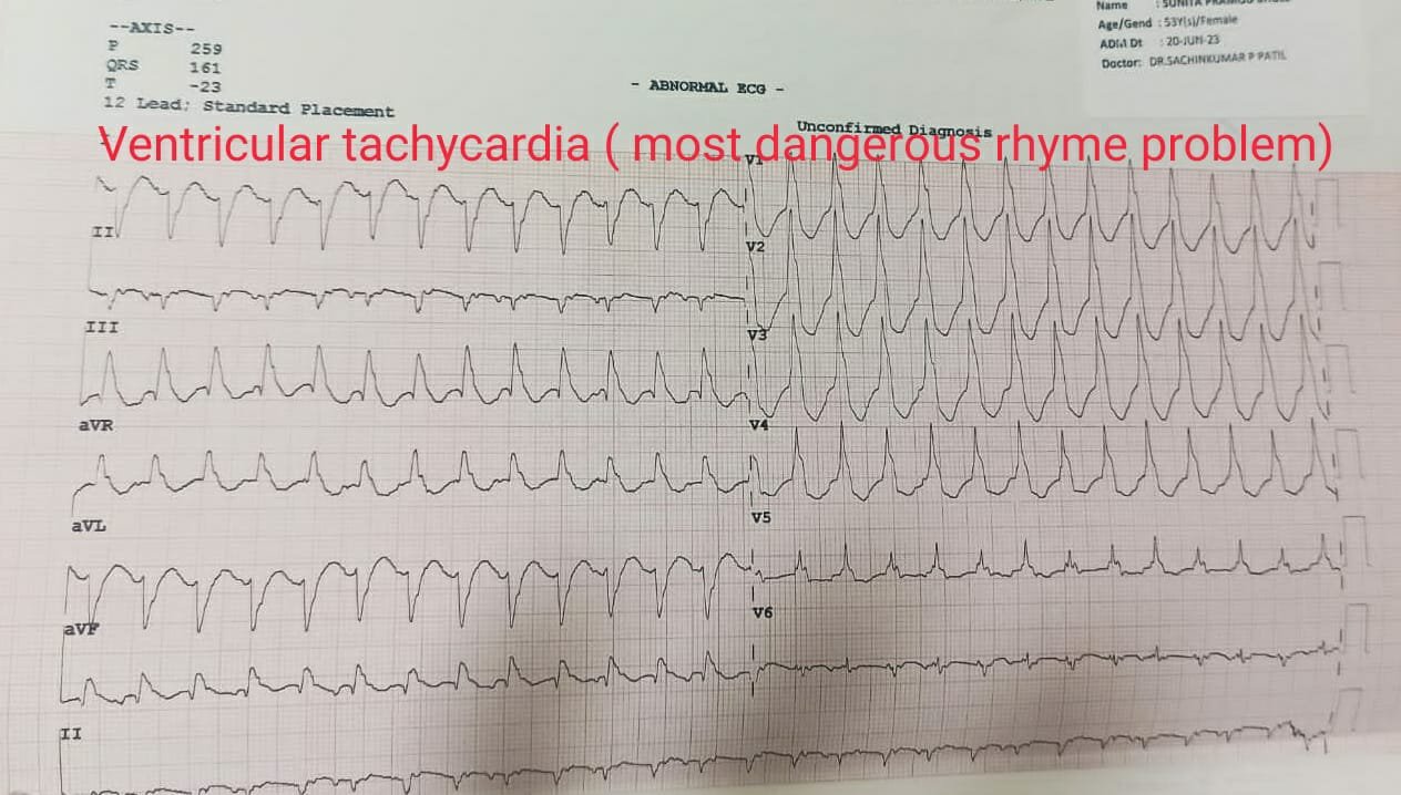 Ventricular - Tachycardia