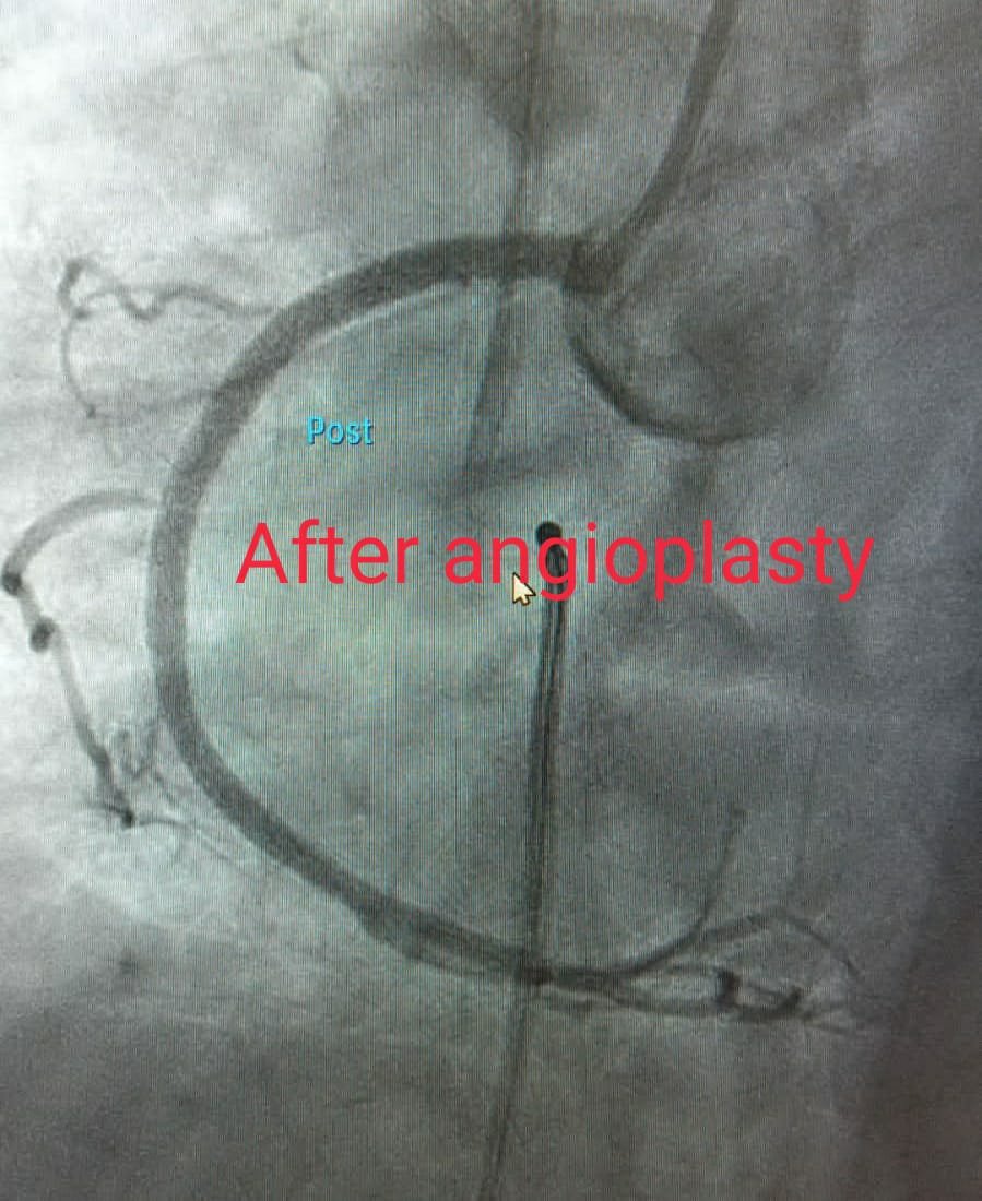 Post Angioplasty