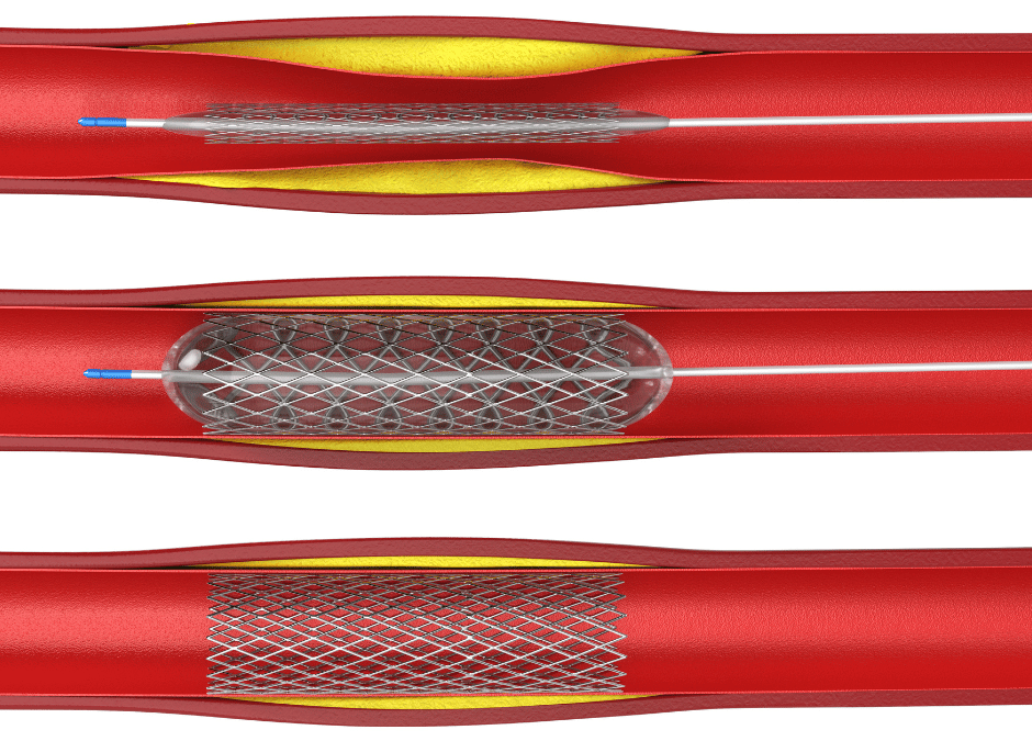 What Is Interventional Cardiology?