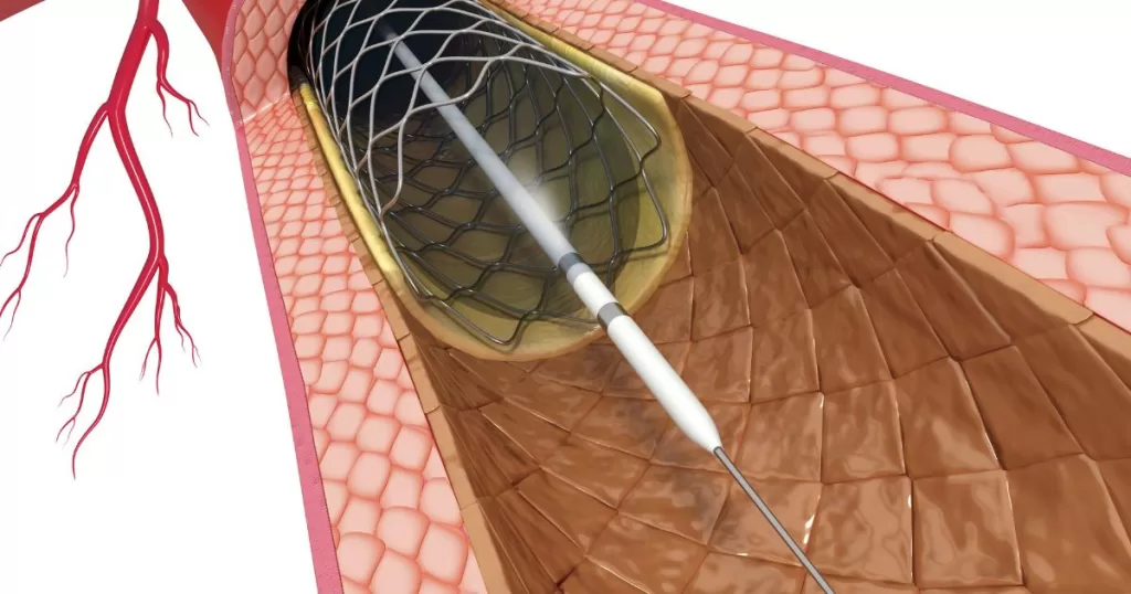 Coronary-Intervention-PCI