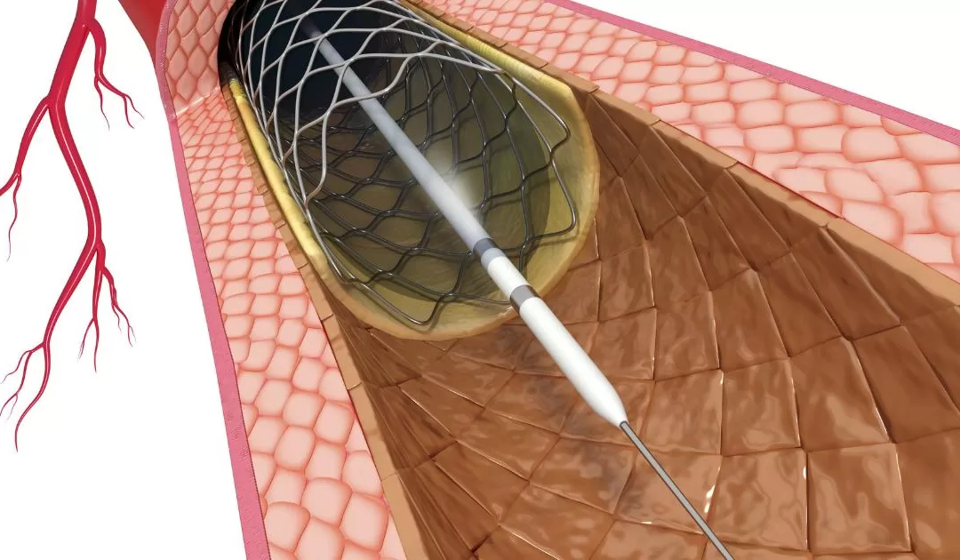 Coronary-Intervention-PCI of modern treatments for heart disease