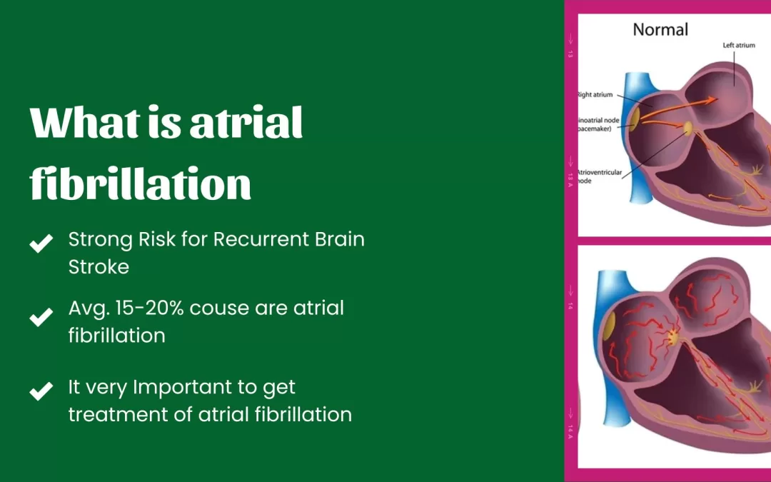 Atrial Fibrillation