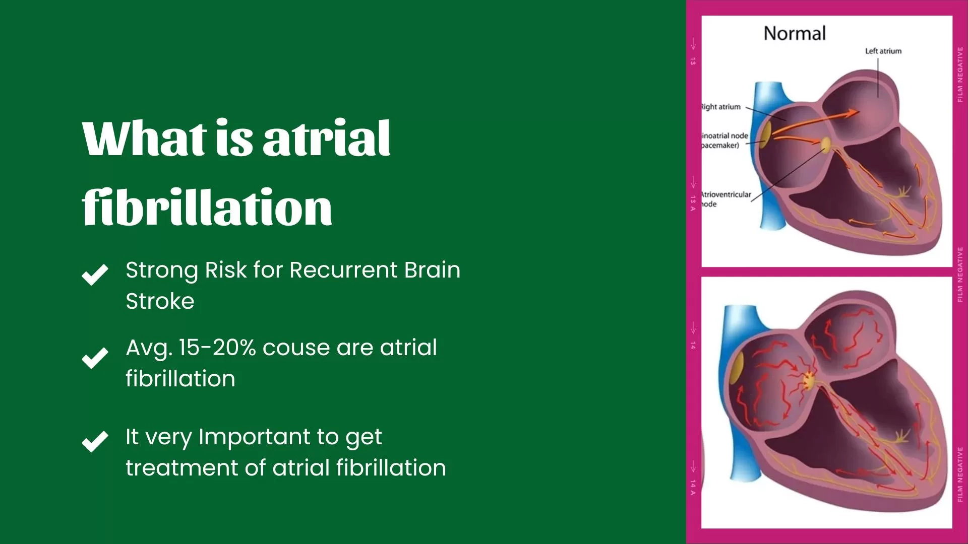 Atrial Fibrillation