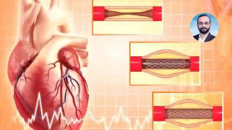 Angioplasty As Gift of Mankind