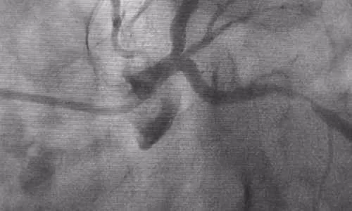 Coronary Angiography (CAG)