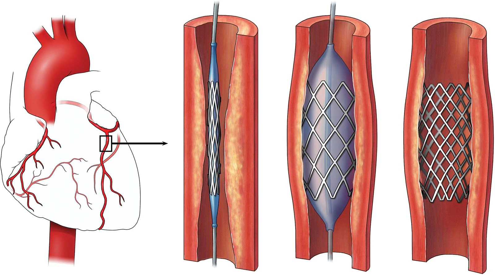 Coronary-Angioplasty Coronary Angioplasty Treatment