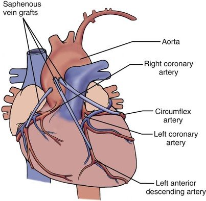 coronary-bypass-treatment2 coronary-bypass-treatment